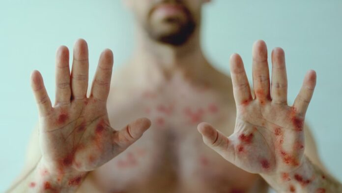 Amazonas registra 33 casos de Mpox; conheça os sintomas e as medidas de prevenção