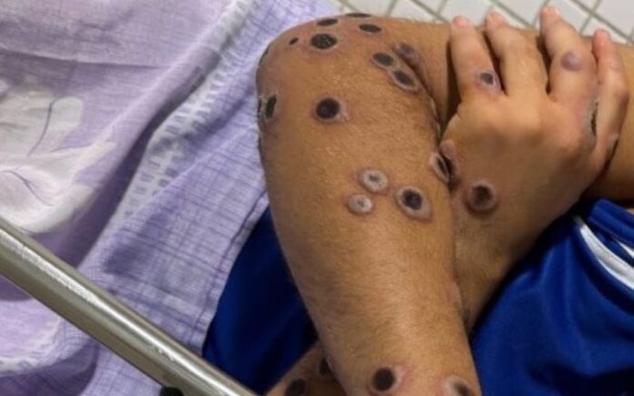 Mpox: Crescimento de Casos Suspeitos no Amazonas e Manutenção dos Confirmados