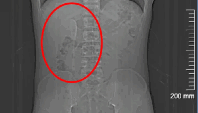 colher-intestino.png Notícias do Amazonas – Homem descobre colher no intestino após confundir com sonho