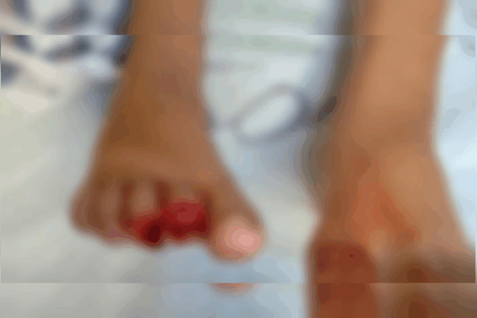 Menino de 9 anos sofre mutilação em ataque de piranhas em Caldas Novas