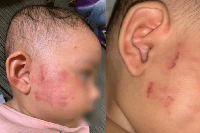 Mãe denuncia creche em Guarulhos após filha voltar com marcas de mordidas
