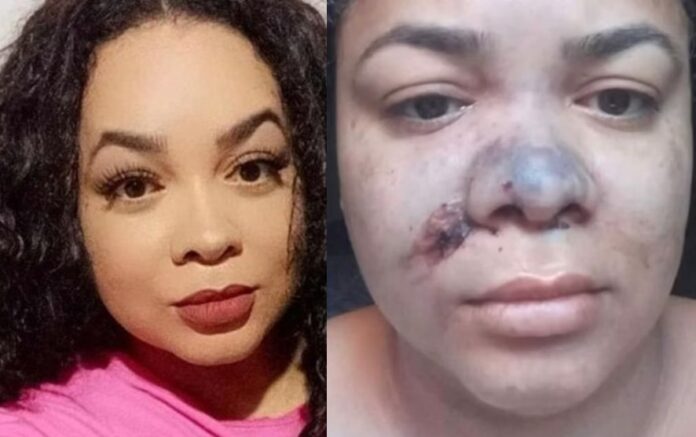 Notícias do Amazonas – Mulher sofre sequelas graves após procedimento estético mal sucedido