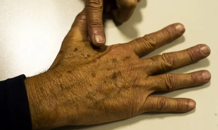 Notícias do Amazonas – Custos hospitalares com melanoma alcançam R$ 4,6 milhões