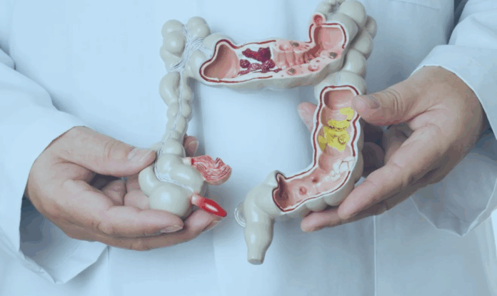 Toxina colibactina da E. coli associada a câncer colorretal em jovens