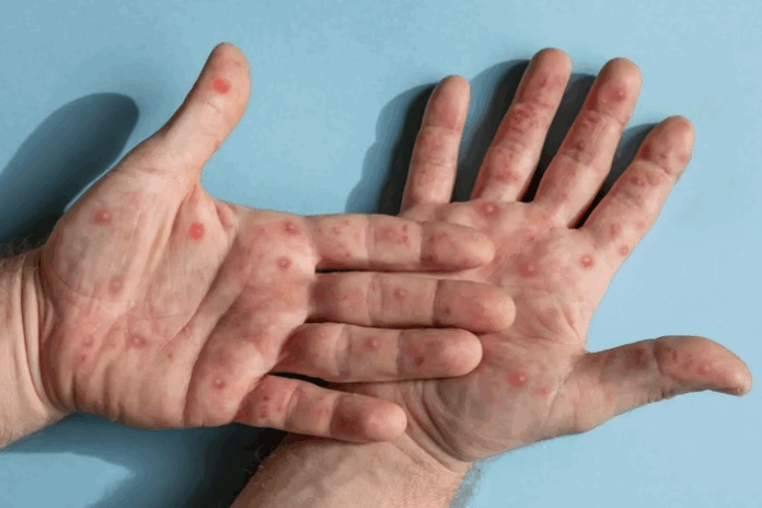 Notícias do Amazonas – Brasil registra primeiro caso da cepa 1b de mpox