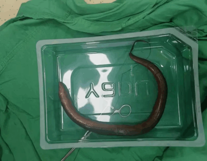 Enguia viva é removida do abdômen de homem após cirurgia na China