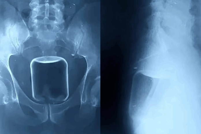 Notícias do Amazonas – Cirurgia remove copo de vidro e objetos do reto de homem