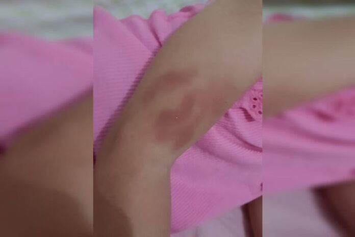 Mãe denuncia creche após filha receber ao menos 20 mordidas