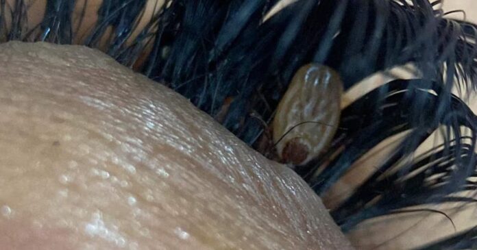 Carrapato é encontrado em cílios de uma mulher