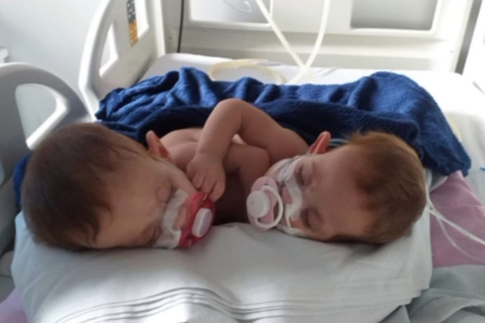 Notícias do Amazonas – Gêmeas siamesas falecem enquanto aguardavam cirurgia de separação