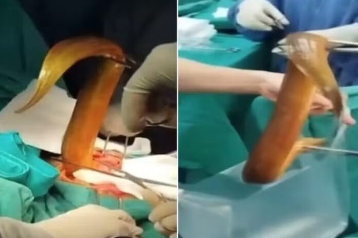 Notícias do Amazonas – Enguia viva causa emergência médica ao morder intestino de paciente