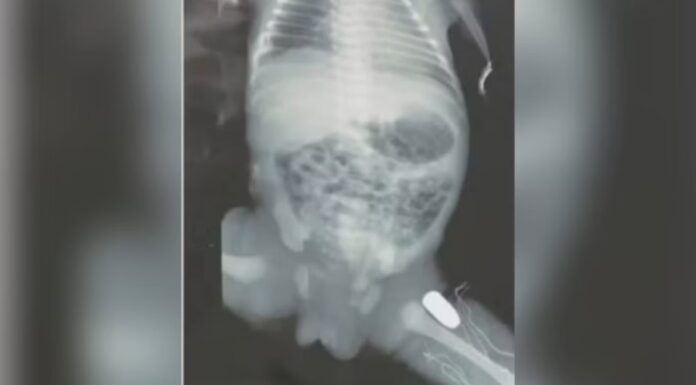 Notícias do Maranhão – Adolescente grávida é baleada e bebê tem projétil na perna